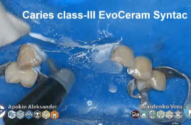 Caries-class-III-EvoCeram-Syntac-Sanctuary-TorVM-FABRI-multistream