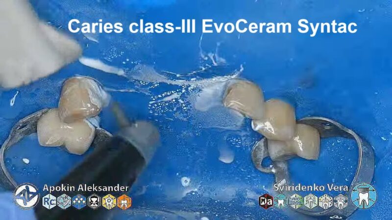 Caries-class-III-EvoCeram-Syntac-Sanctuary-TorVM-FABRI-multistream
